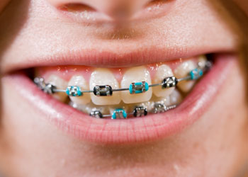 Coloured Braces, Surrey, BC