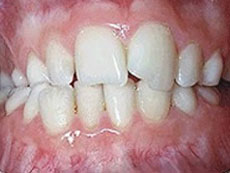 Cross Bite, Guildford Orthodontic Centre, BC