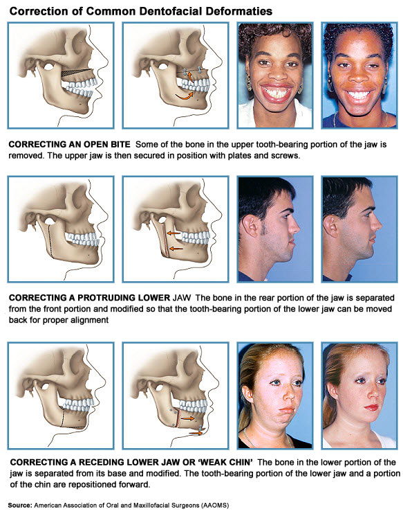 Dentofacial Orthodontic Surgery, Surrey, BC