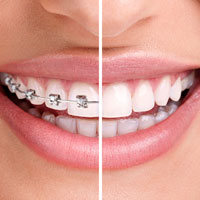 Invisalign, Clear Braces, Surrey