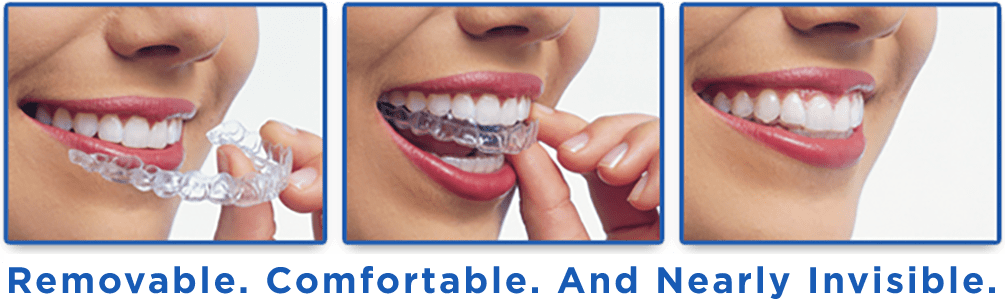 Invisalign Clear Braces, Guildford Orthodontic Centre, Surrey