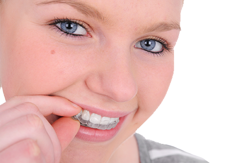 Invisalign Teen Clear Braces, Dentist Surrey