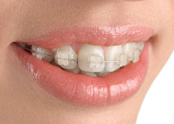 Translucent Cosmetic Braces, Surrey, BC